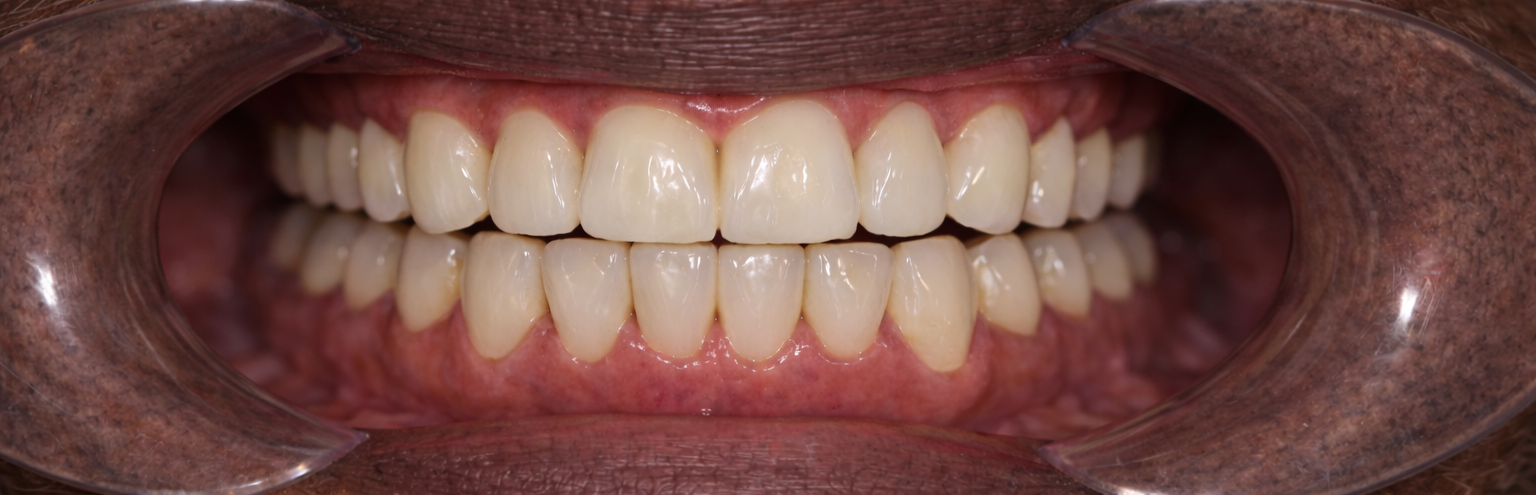 Dopo il trattamento impianti dentali