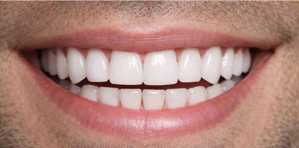 Dopo il trattamento faccette dentali