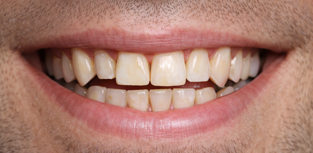 Prima del trattamento faccette dentali